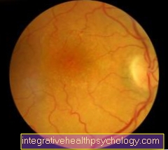 tromboză a vederii centru medical oftalmologic vitreum satu mare
